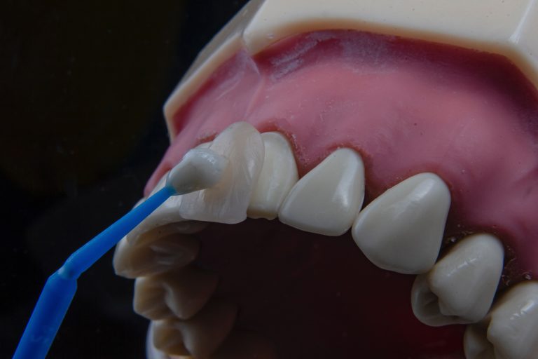 Services - Dental Veneers